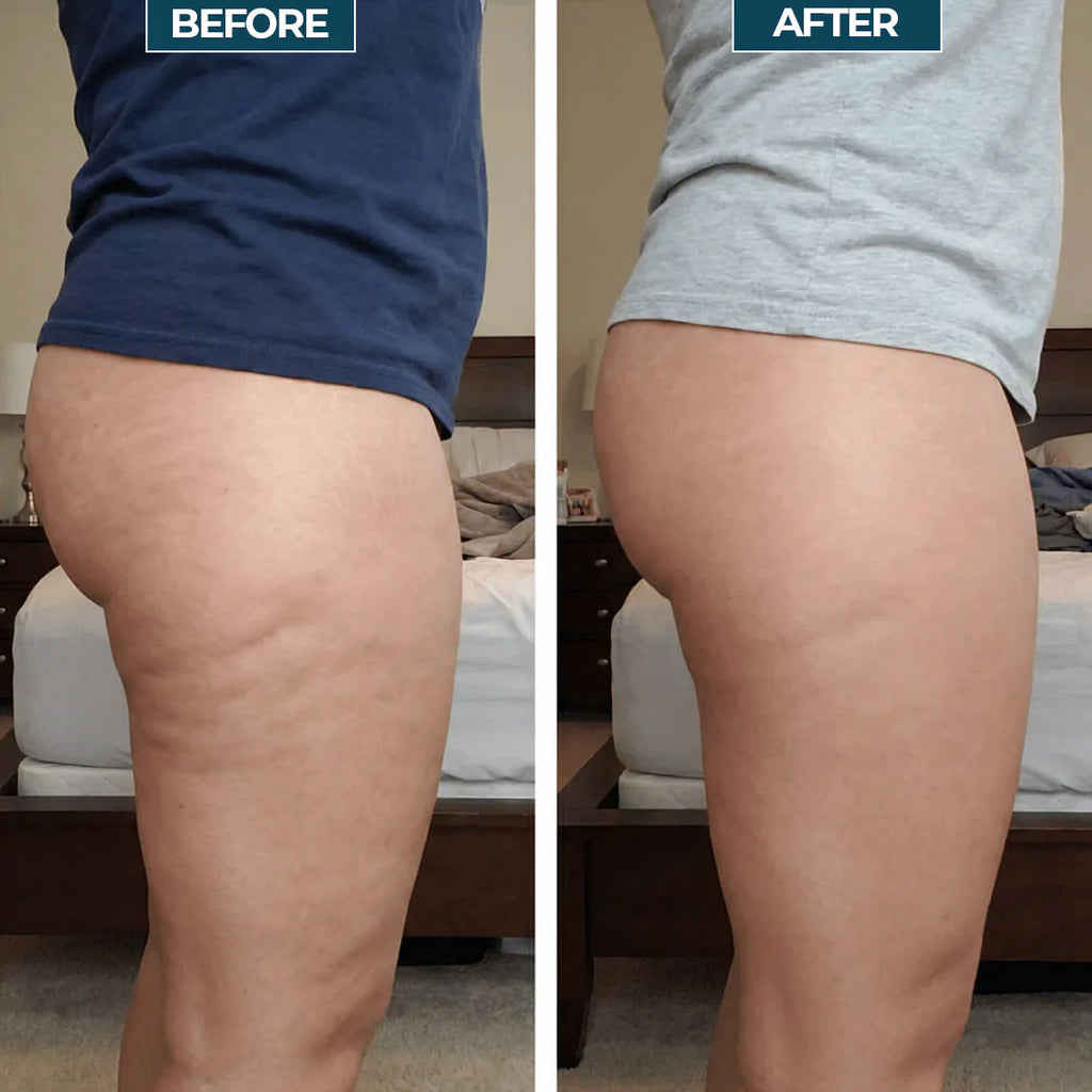 Anti-cellulitis lymfatische rolmassageapparaat