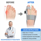 Bunion Corrector — Hallux Valgus Brace